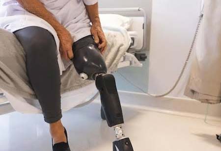Gold Standard Considerations in Lower Limb Prosthetic Care